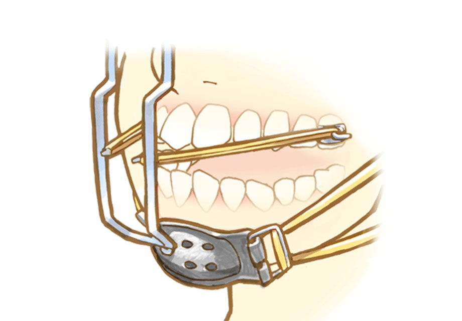 受け口の場合に使用する矯正装置『上顎前方牽引装置』