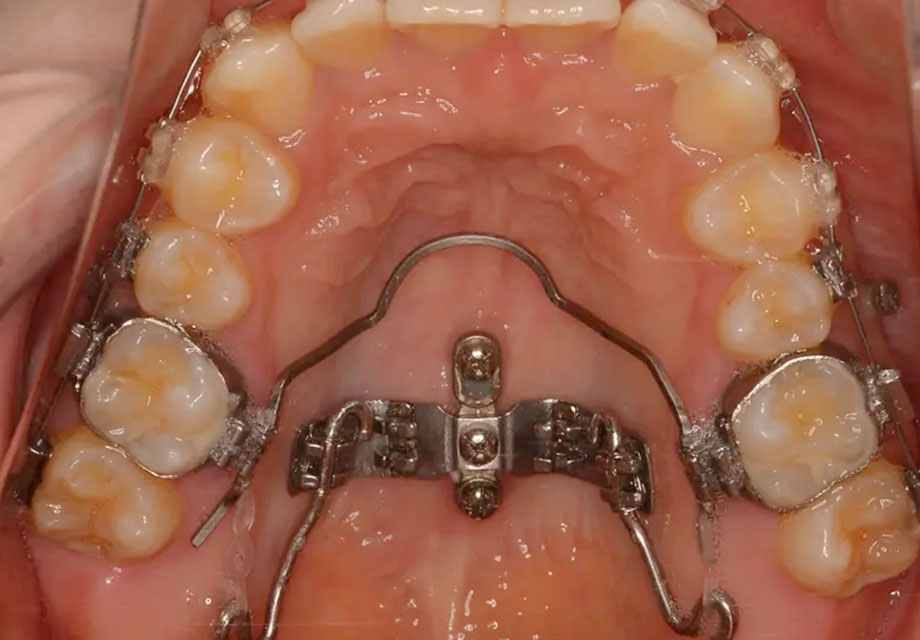 3次元的に歯を動かすことを可能にする口蓋型歯科矯正用アンカースクリュー（i-station）