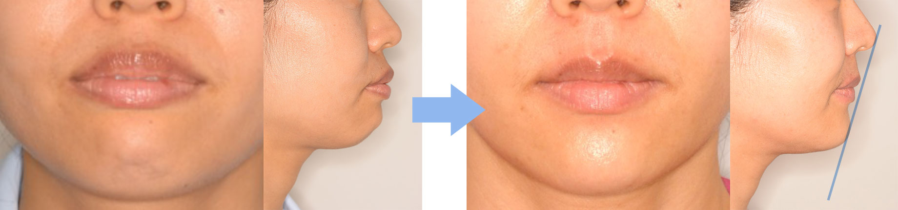 上下唇の位置をE-lineより2mm程度後方に改善した治療例